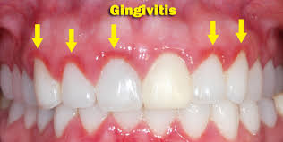 close up of a mouth with gingivitis