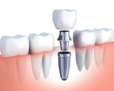 3d illustration of a dental implant