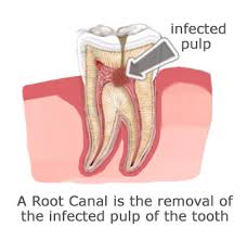 3d image of infected pulp in tooth